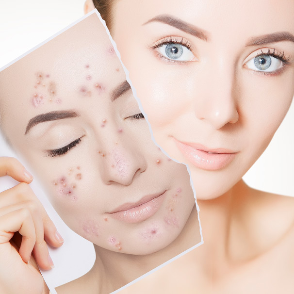 Dealing With Adult Acne